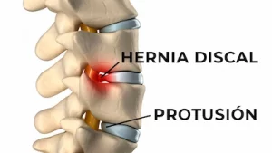 hernia-discal-versus-protusion-discal