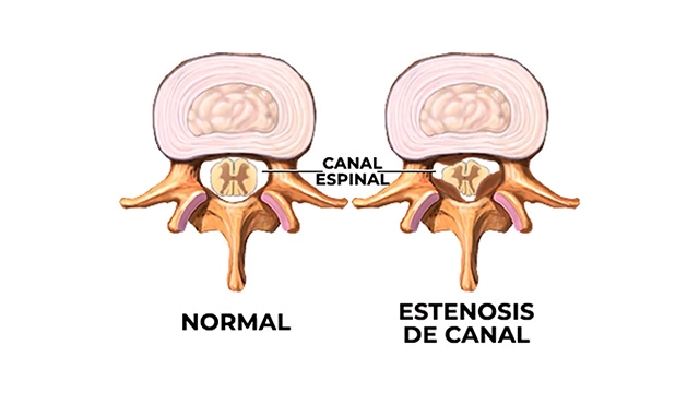 estenosis-de-canal-y-canal-espinal-normal